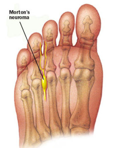 Crag-Daddy and the Morton’s Neuroma… | Cragmama